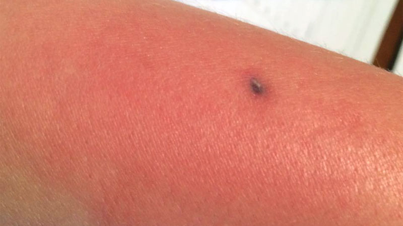 Baby Brown Recluse Bite