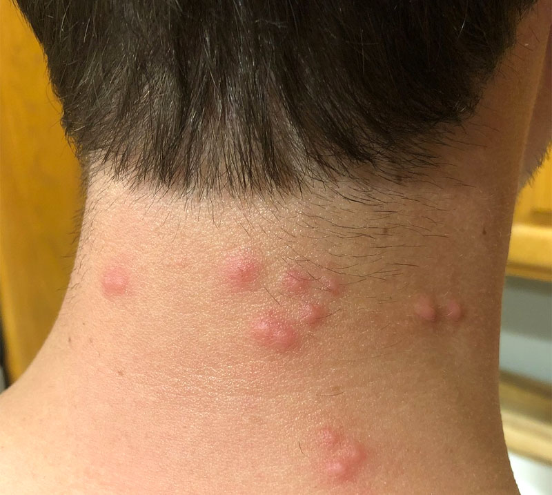 bed bug bites on face and neck