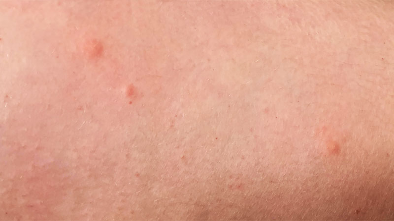 bird mite bites